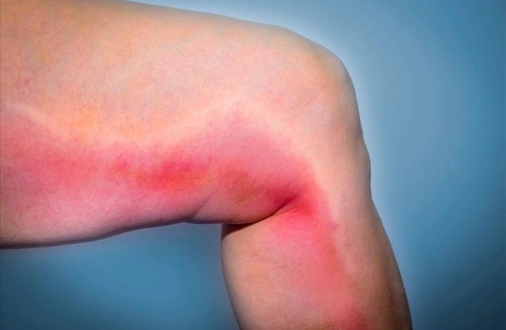 Flebitis