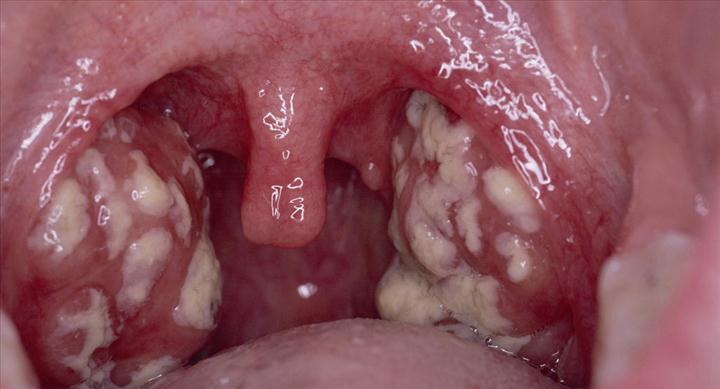 amigdalitis